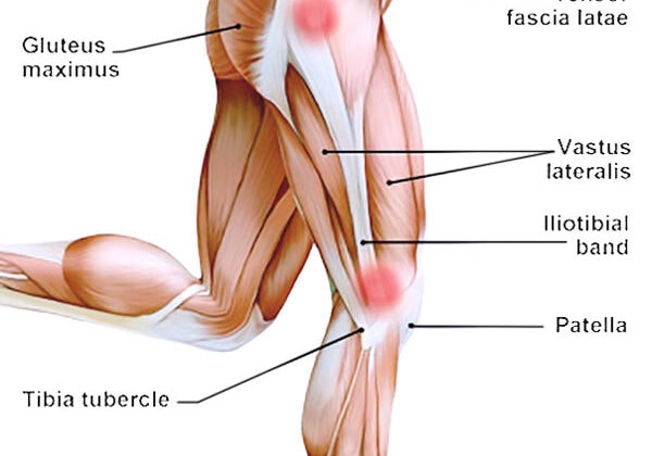 Infographic - Iliotibial Band Syndrome (TBS)